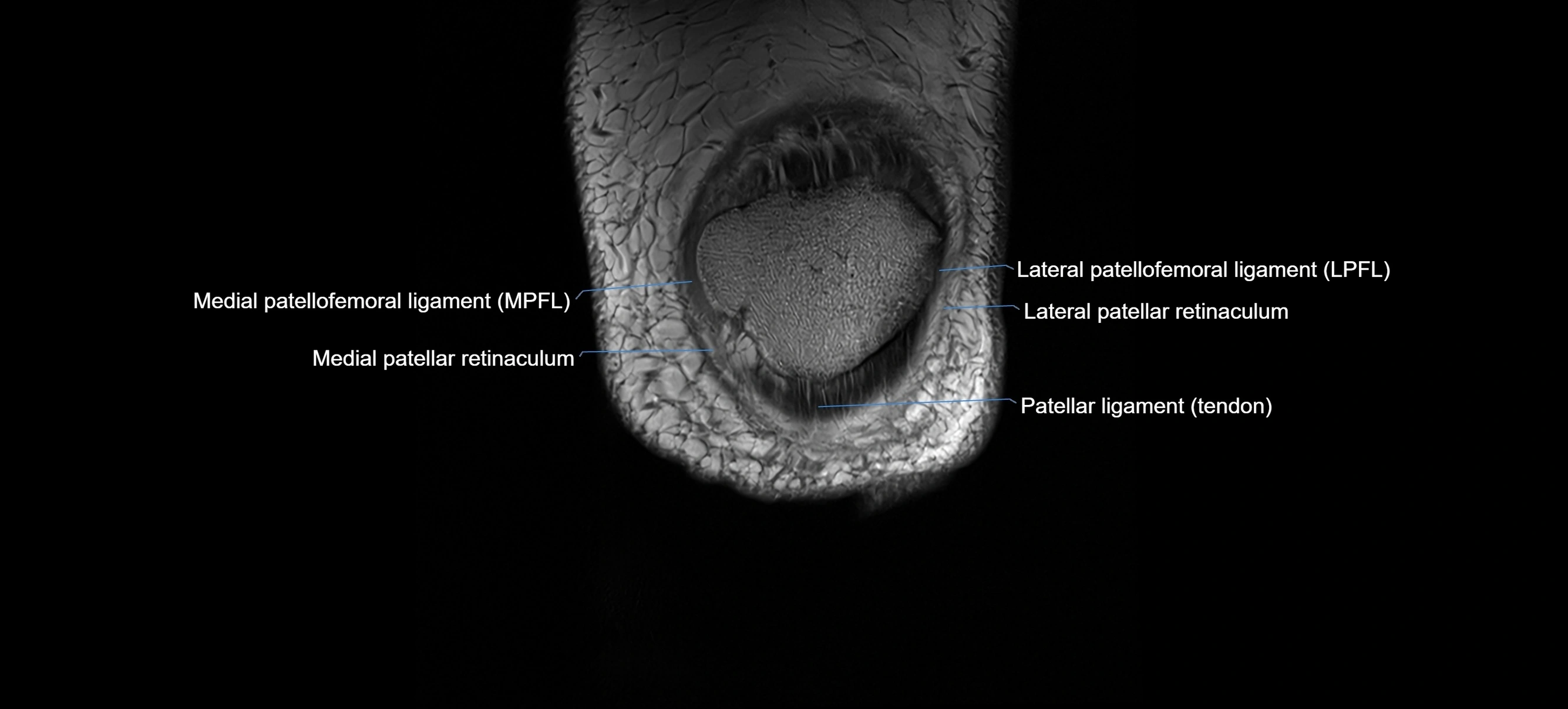 MRI coronal  ligaments cross sectional anatomy 3T  radiology  image-img-04001-00004.webp